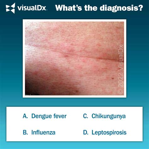 Woman Has Fever Rash Following Tropical Vacation Lets Diagnose