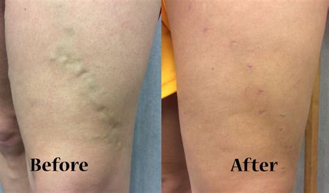 Varicose Veins Pictures Before And After Symptoms And Pictures