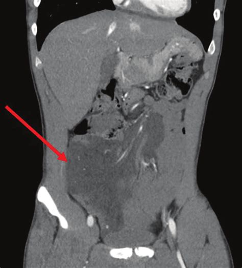Computed Tomography Coronal View Showing The Mesenteric Lymphangioma