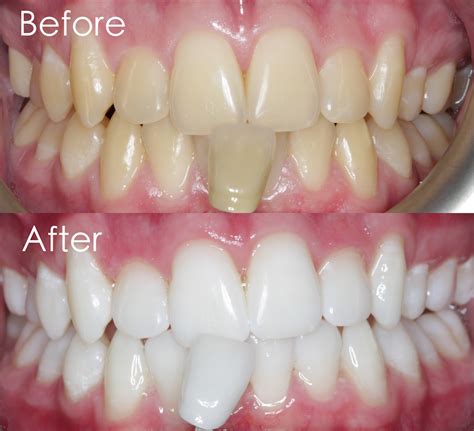 Enlighten Before And After At The Tracey Bell Clinic Teeth Whitening