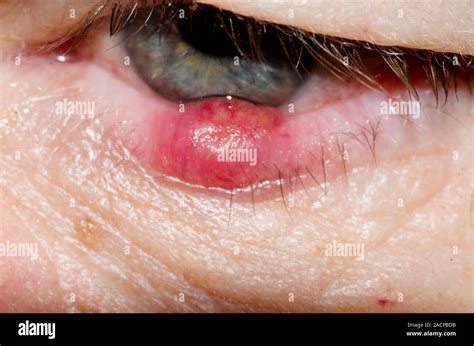 Chalazion Eyelid Cyst Or Meibomian Cyst Lump In Eyelid Causes Hot Sex