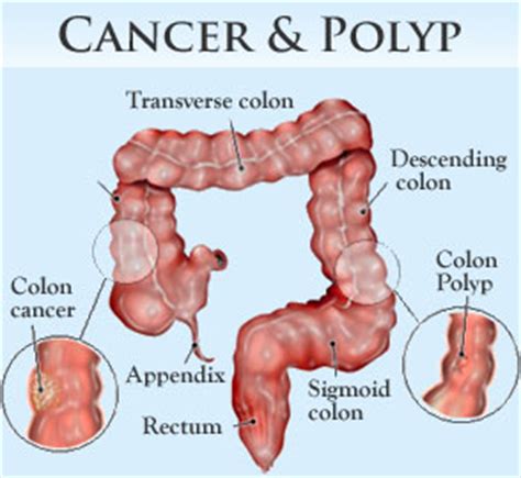 Signs and symptoms of colon cancer tend not to be specific. Colon Cancer - Adirondack Gastrointestinal & Colorectal ...