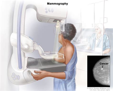 Breast Cancer Screening Pdq®patient Version Nci