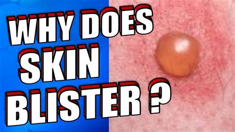 Why Does Skin Blister How To Treat And Prevent Skin Blisters Naturally