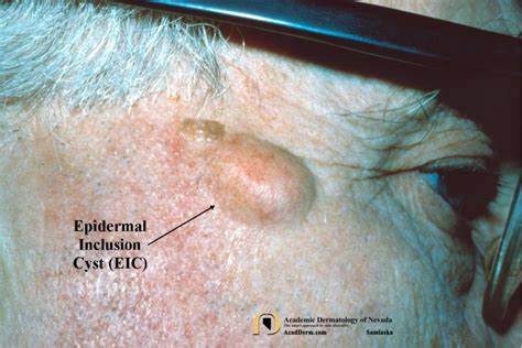 epidermal inclusion cysts eic epidermoid cysts academic dermatology of nevada