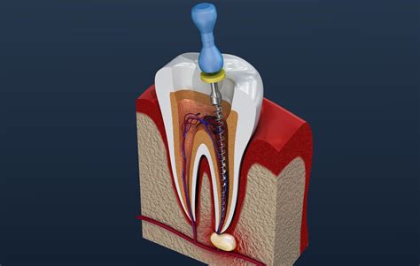 Reasons Why Root Canal Therapy Is Recommended - Braeside Dental Centre