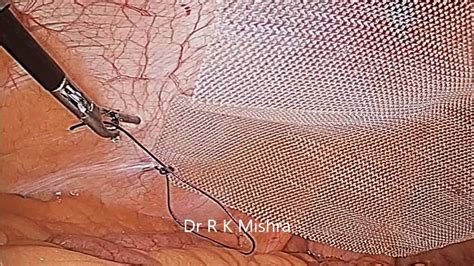 Laparoscopic Repair Of Para Umbilical Hernia By Dr R K Mishra Youtube