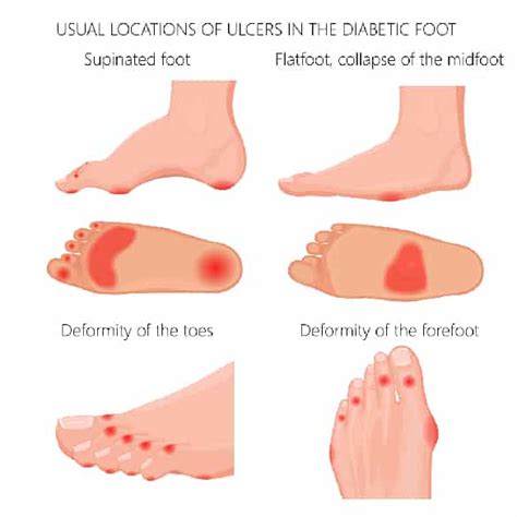 Diabetic Foot Ulcers Brisbane Brisbane North Podiatry Clinic