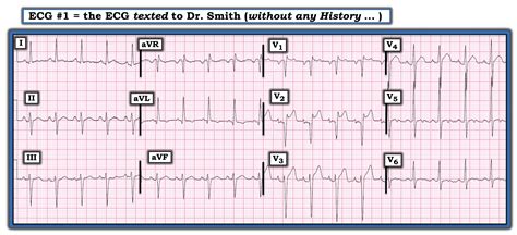 Dr Smiths Ecg Blog Is This Septal Stemiomi Many Examples Of Septal