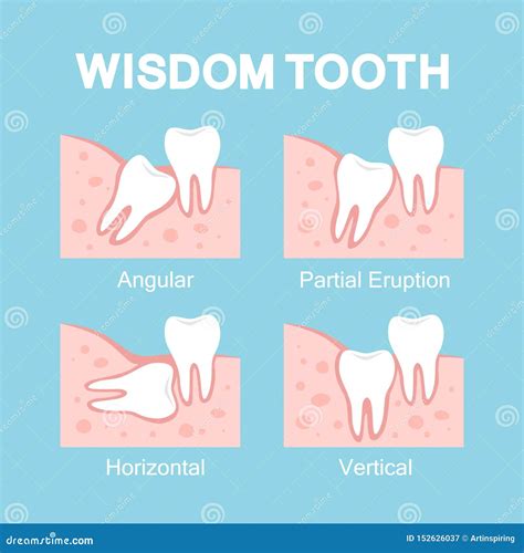 Abnormal Eruption Of Wisdom Tooth Dental Problems Stock Vector