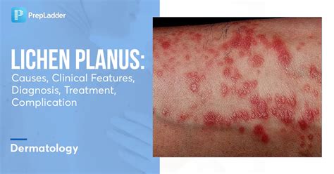 Lichen Planus Causes Clinical Features Diagnosis Treatment