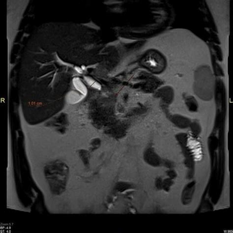 A Ct Scan Of The Abdomen Showing The Ill Defined Lesion And Dilated