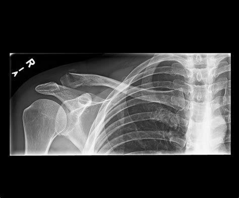 Orthodx Lateral Clavicle Fracture Clinical Advisor