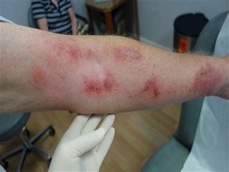 Red Itchy Rash On Arms