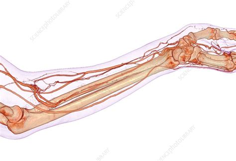 Forearm Blood Vessels 3d Ct Angiogram Stock Image C0374680