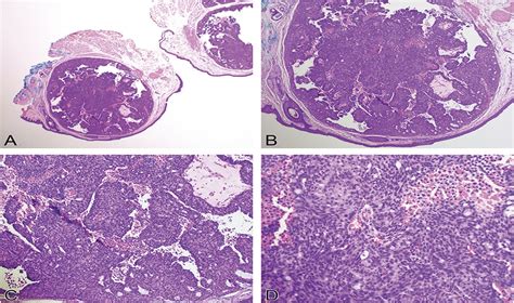 Endocrine Mucin Producing Sweat Gland Carcinoma In An Elderl The
