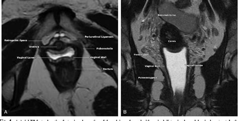 Figure 1 From Vaginal Anatomy On Mri New Information Obtained Using Distention Semantic Scholar