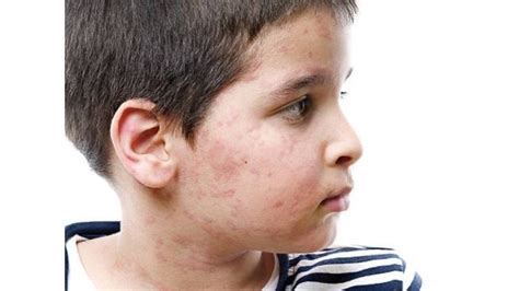 أنواع الأمراض الجلدية عند الأطفال وكيفية التشخيص والعلاج