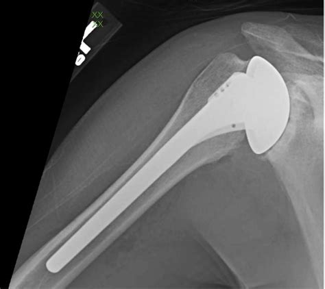 Uw Shoulder And Elbow Academy Stemless Humeral Components What Is