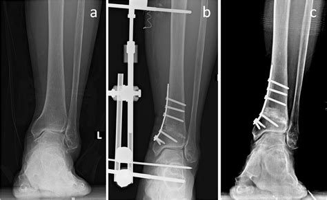 Supramalleolar Osteotomy With Medial Distraction Arthroplasty For Ankle
