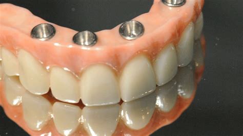 Maxillary Arch Implant Supported Fixed Zirconium Prosthesis Denture
