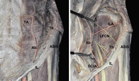 Maybe you would like to learn more about one of these? Dissection of the abdominal wall and the iliac fossa ...