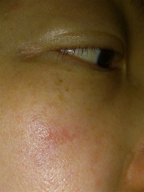 Red Bump On Face