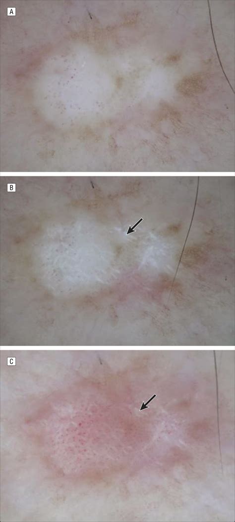 Conventional And Polarized Dermoscopy Features Of Dermatofibroma