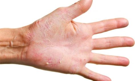Rough Severely Dry Skin On Hand Causes And Treatment Skincarederm