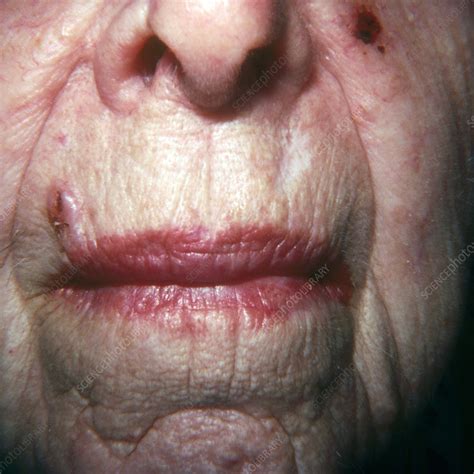 Basal Cell Carcinoma Stock Image C0430673 Science Photo Library