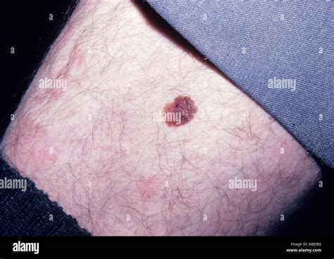 Mole Benign Nevus On Skin Non Cancerous Stock Photo Alamy