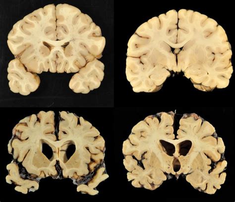 Cte Faq How Repeated Head Blows Affect The Brain Nbc 10 Philadelphia