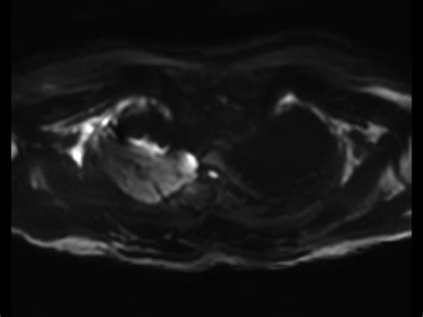 Brachial Plexus Tumor Philips Mr Body Map