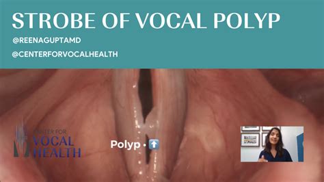 Strobe Of A Vocal Polyp A Common Voice Injury With Dr Reena Gupta