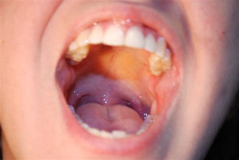 This condition can include the tiny purple spots on the skin's surface. Roof Of Mouth Is Yellow - Xxx Porn Trailer