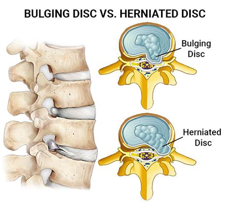 What Happens If A Bulging Disc Goes Untreated The Spine And Rehab Group