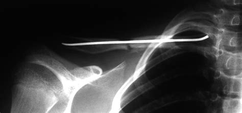 Elastic Stable Intramedullary Nailing Of Midclavicular Fractures In