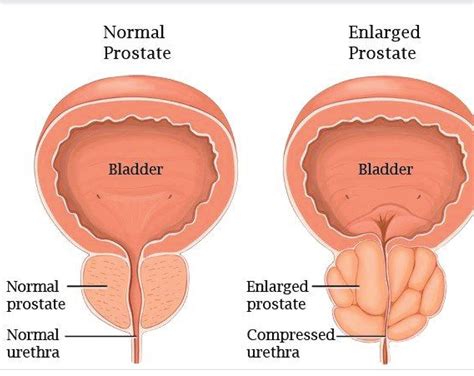 Benign Prostate Enlargement Or Hyperplasia Dubai Healthcare City Westminster Ortho Med Clinic