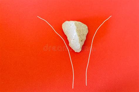 Stone Stuck In Narrow Place Stock Photo Image Of Health Trouble