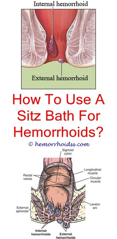 Thrombosed hemorrhoids are not considered to be. How Does De Hemorrhoid Cream Work? what to do when your ...