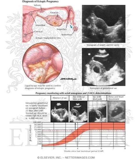 Diagnosis Of Ectopic Pregnancy