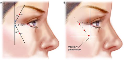 Pdf Onabotulinumtoxina For Treatment Of Moderate To Severe Crows Feet Lines A Review