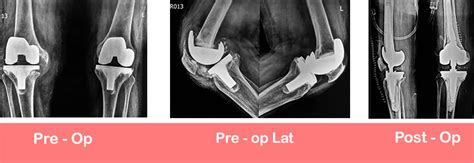 Revision Total Knee Replacement Sant Parmanand Hospital