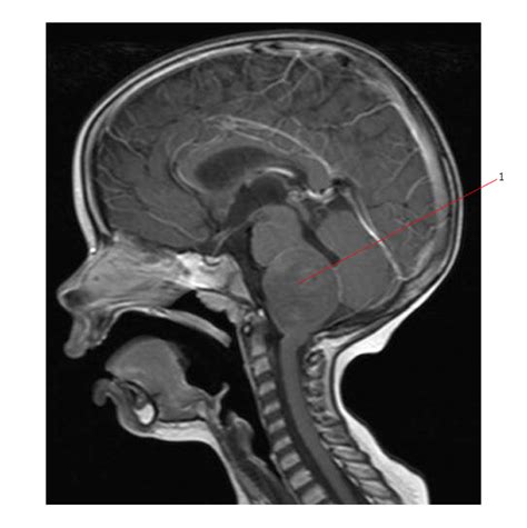 Brain Stem Glioma Radiology