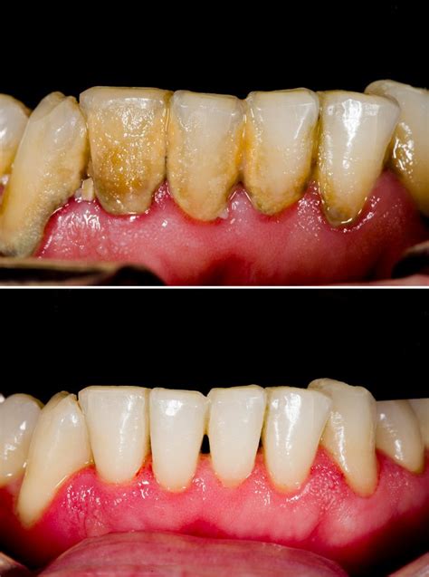 Periodontal Disease Gum Disease Tuxedo Dental Group