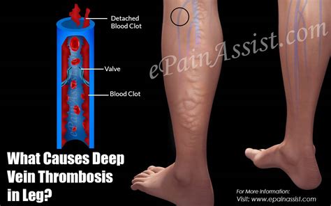 What Causes Dvt Or Deep Vein Thrombosis In Leg