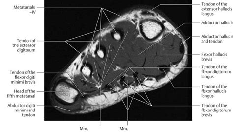 Muscle mri sequences & patterns asymmetric myopathy hereditary acquired connective tissue neurogenic. Ankle and Foot | Radiology Key