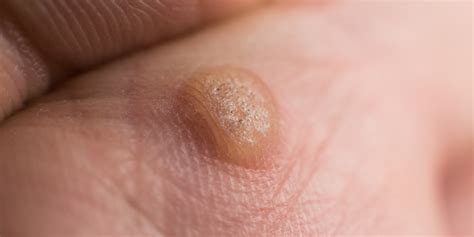 Warts San Luis Obispo CA Coastal Dermatology Aesthetics