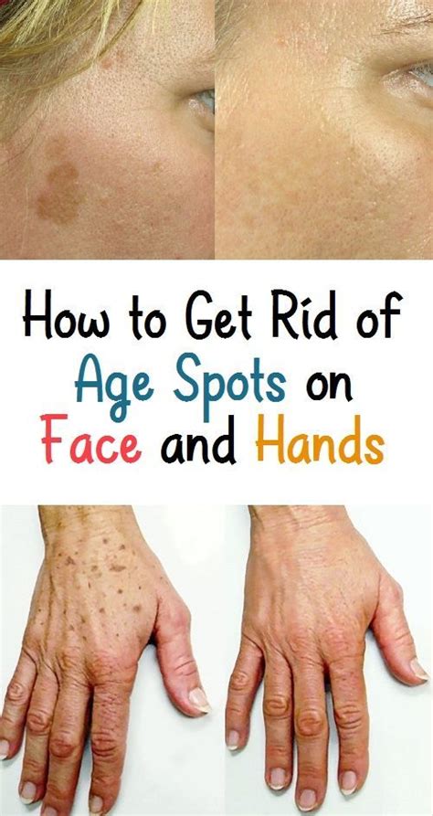 How To Get Rid Of Age Spots On Face And Hands Age Spots On Face