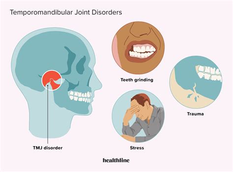 Tmj Temporomandibular Joint Disorders Symptoms And More